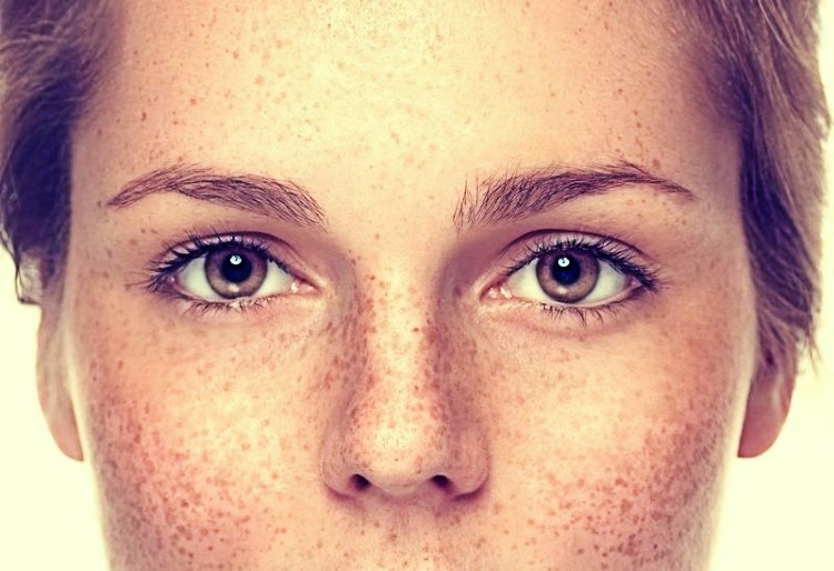 Brown spots: why appear and how to treat