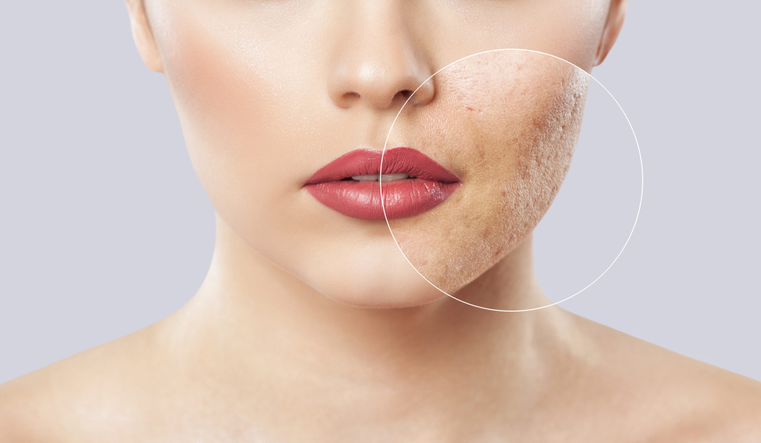 7 Reasons Microdermabrasion is the Best Treatment for Acne