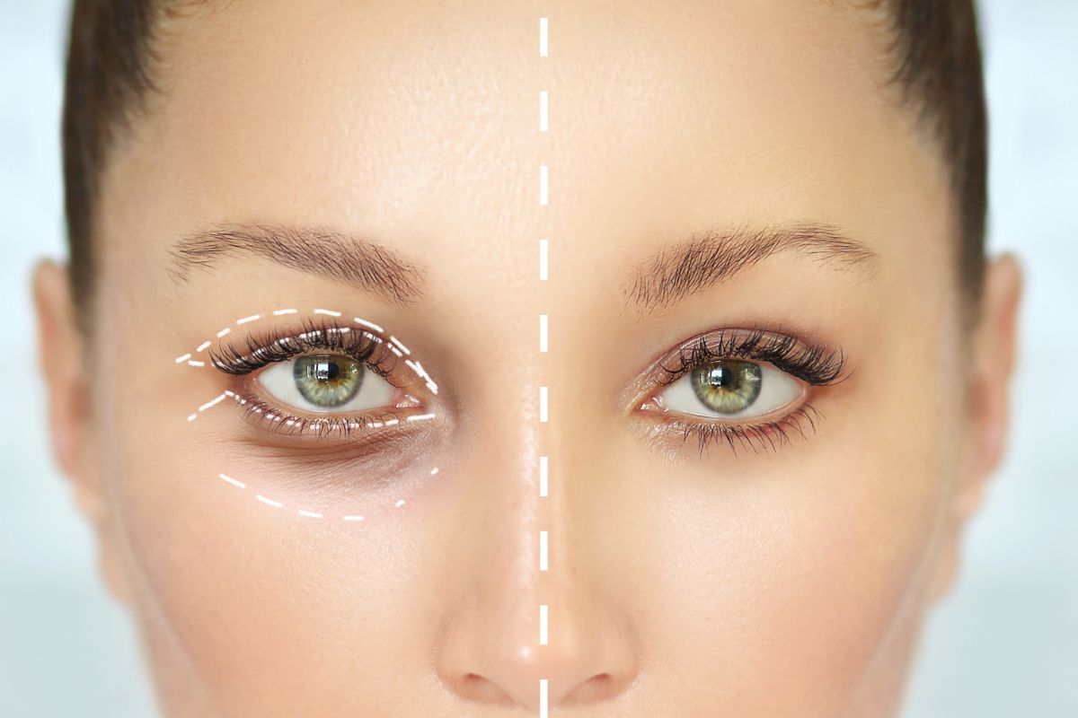 What to Expect After a Transconjunctival Blepharoplasty