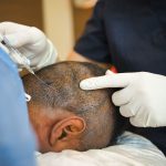 Unlocking the Secrets - All About Hair Transplant