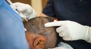 Unlocking the Secrets – All About Hair Transplant