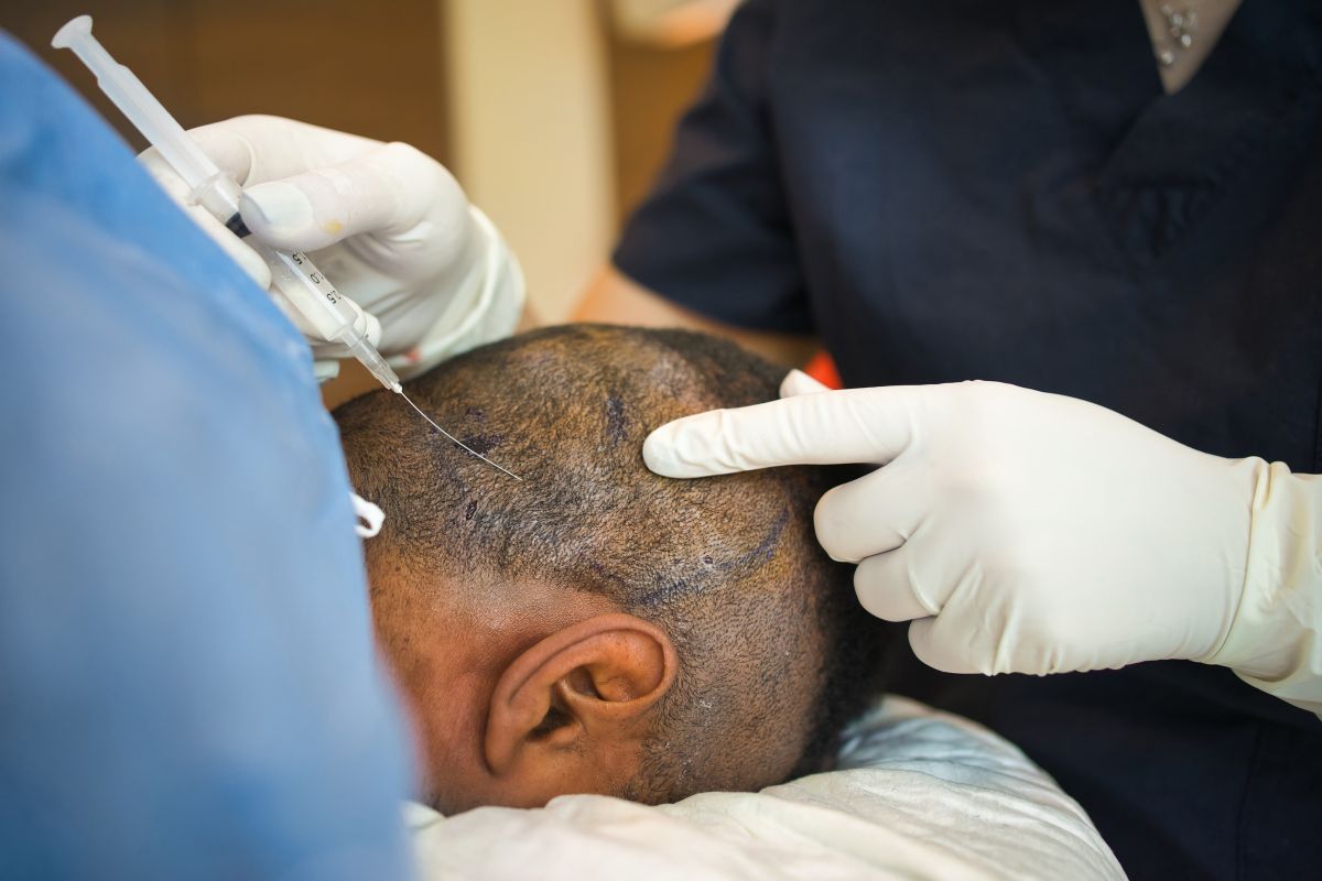 Unlocking the Secrets – All About Hair Transplant