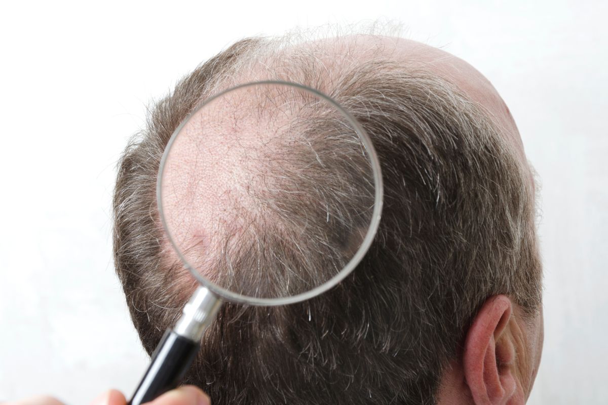 Understanding Hair Transplant