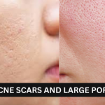 Pores and Acne Scars - Unveiling the Secrets to Clear Skin