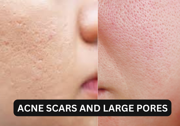 Pores and Acne Scars – Unveiling the Secrets to Clear Skin