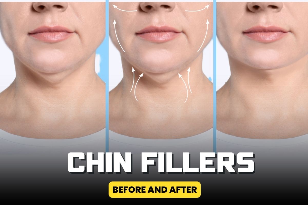 Chin Filler Before And After