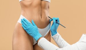 Five Lifestyle Changes to Make After Tummy Tuck