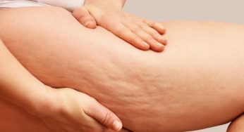 Connection between Weight Loss and Loose Skin Removal