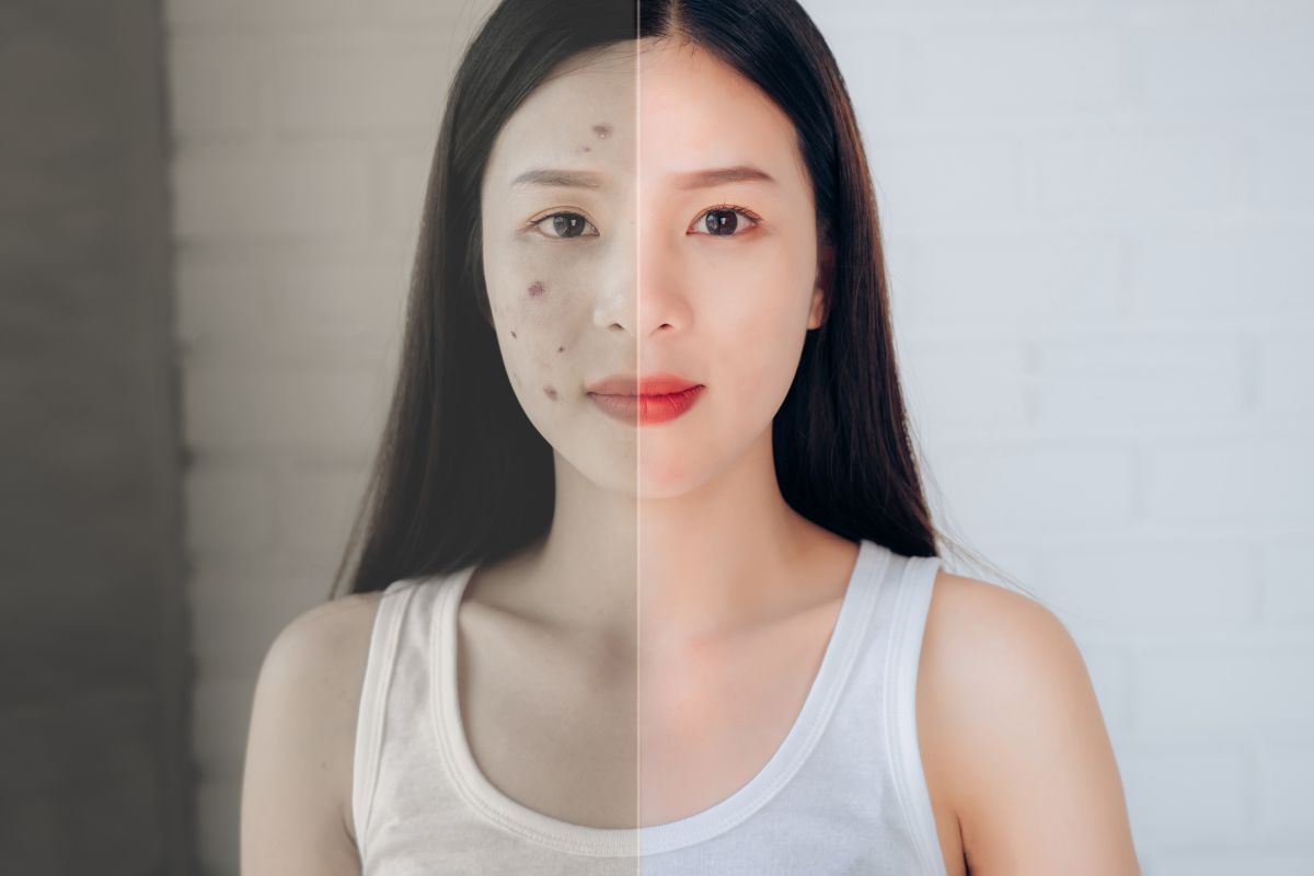 Dermadew Acne Face Wash –  A Complete Guide